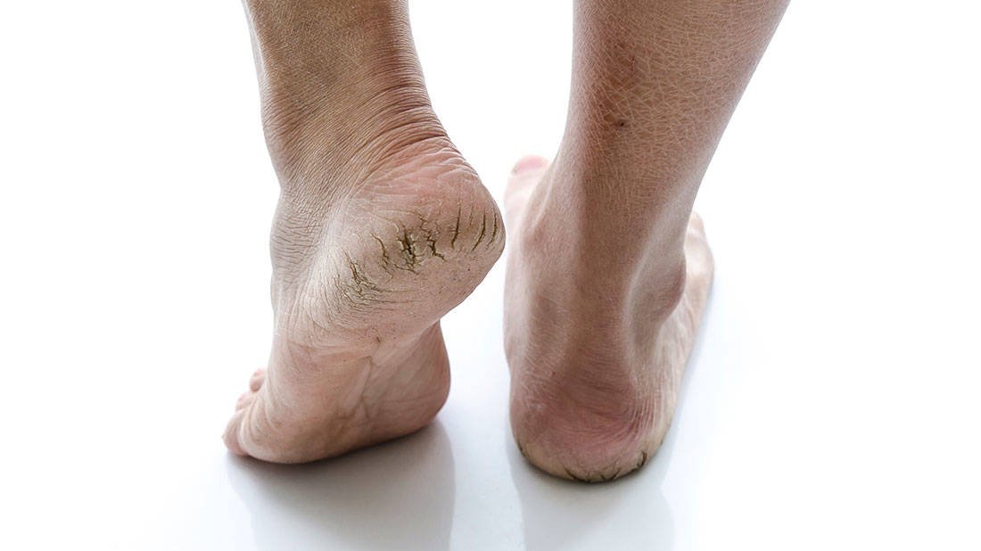 cracked feet