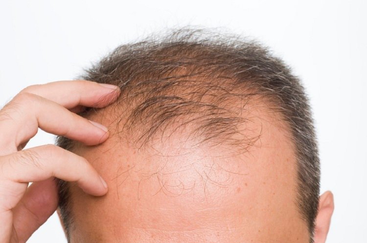 Baldness problems